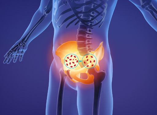 만성 골반염증성 질환