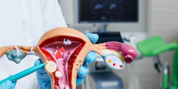 연령에 따른 기능성 자궁출혈