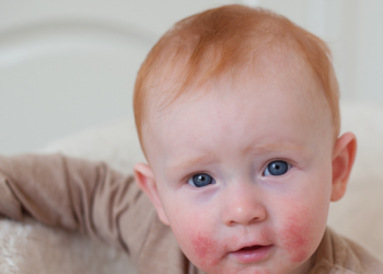 소아 아토피(Atopic Dermatitis)란?