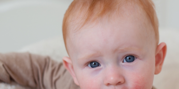 소아 아토피(Atopic Dermatitis)란?