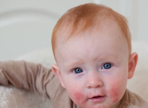 소아 아토피(Atopic Dermatitis)란?